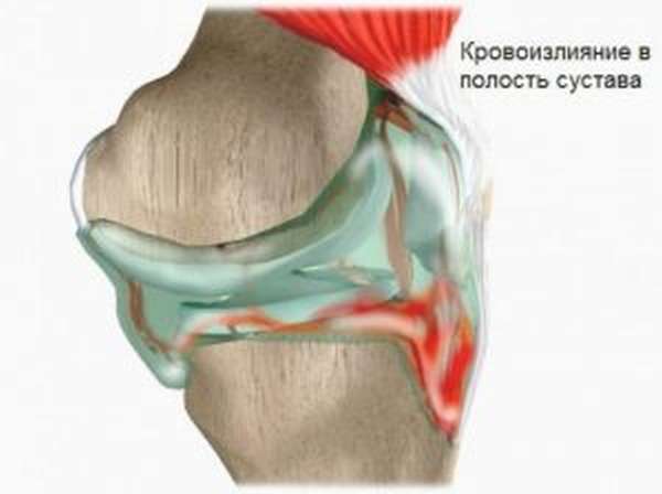 Перелом в колене